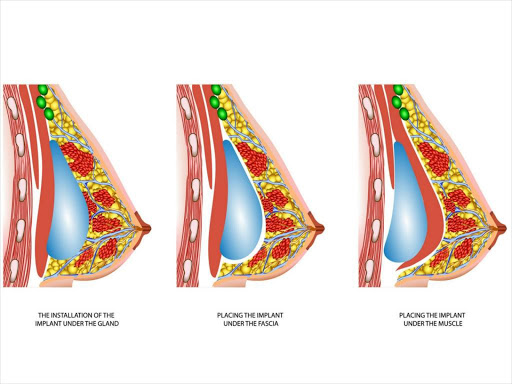 Expert comment: How fat transfer breast augmentation works