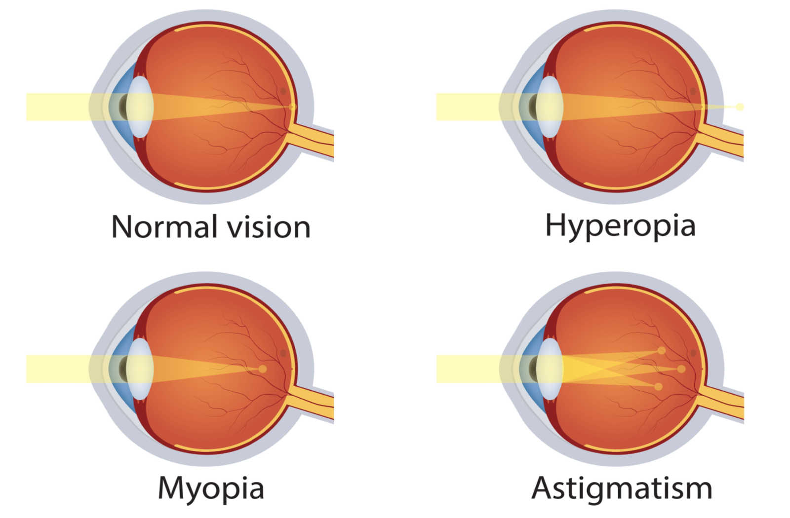 An illustration showing vision impairments like nearsightedness, farsightedness, and astigmatism.