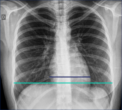 Anatomia radiográfica do coração e dos vasos da base - imagem 3