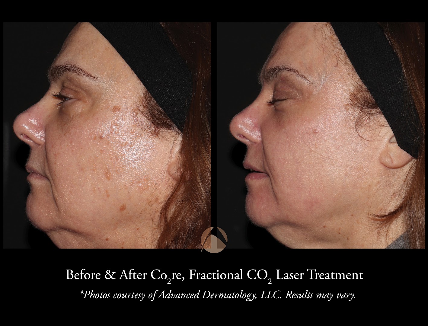 CO2 Laser Resurfacing & Patient Results 