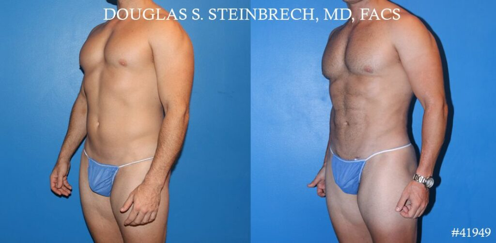 male liposuction before and after in new york