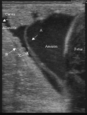 Ultrasonografía transabdominal y transrectal de la placenta de una yegua durante el noveno mes de gestación. La flecha señala el área de separación placentaria.