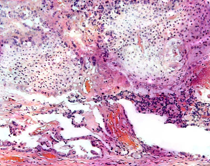 Base of placenta with endometrial gland remnants and debris below.