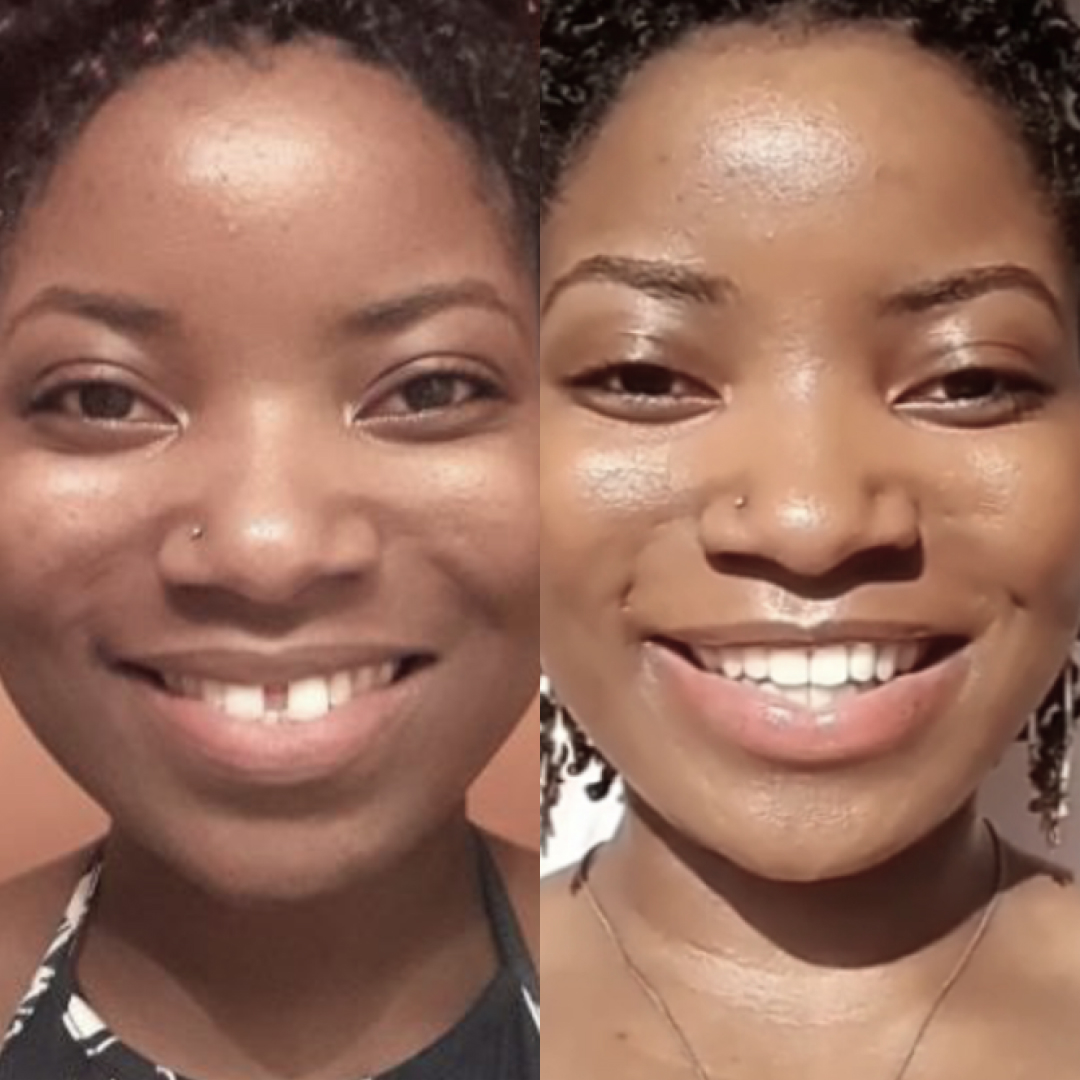 before and after pictures of a woman who had a space in between her front teeth 