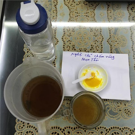 Hết công thức trị mụn bằng trứng gà, mẹ còn bày cách trị mụn bằng nghệ vàng.