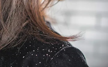 dandruff