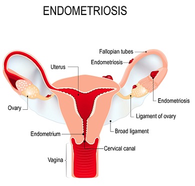 One in ten women suffers from Endometriosis.