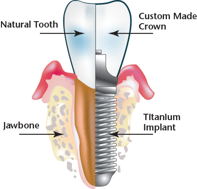 dental-implant.png