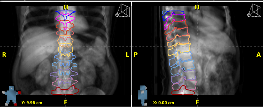 Radformation AutoContour Vertebral Bodies