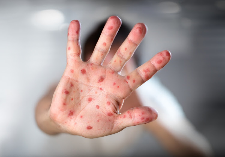 Despite some similar symptoms, measles is different to Covid-19. File photo.